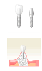 自分の歯に近い補綴治療～インプラント～